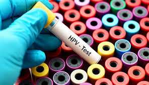 آزمایش غربالگری HPV